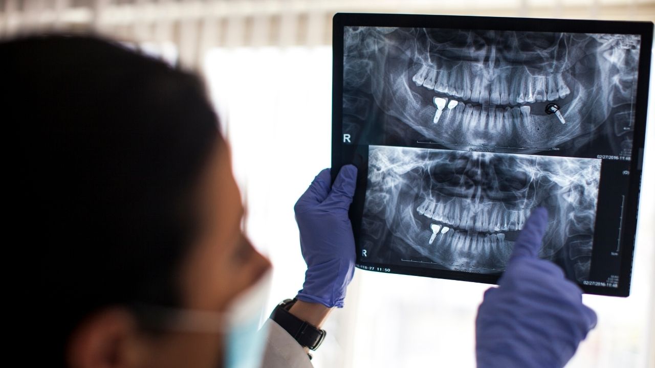 Dental Implants